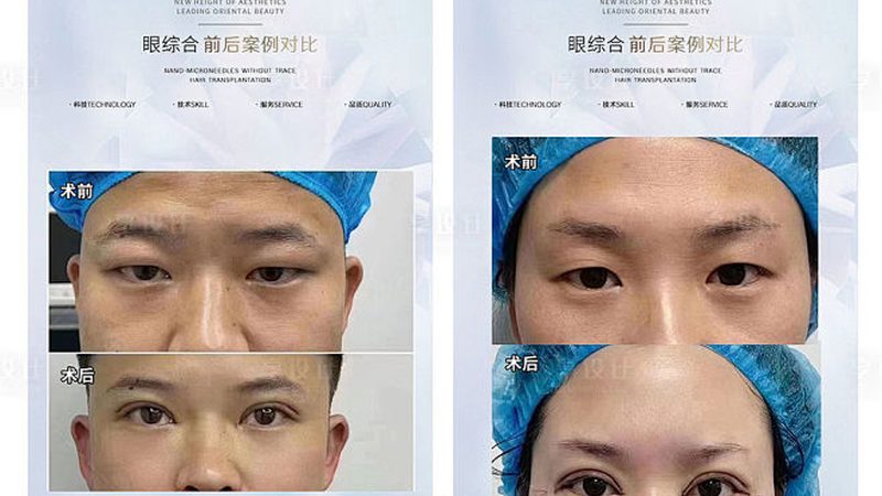 目前市面上常见的蛋白线材质主要有以下几种：