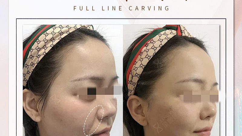 医美后居家护理怎么做