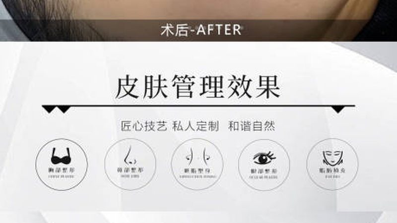 激光祛斑多少钱能保证不反弹
