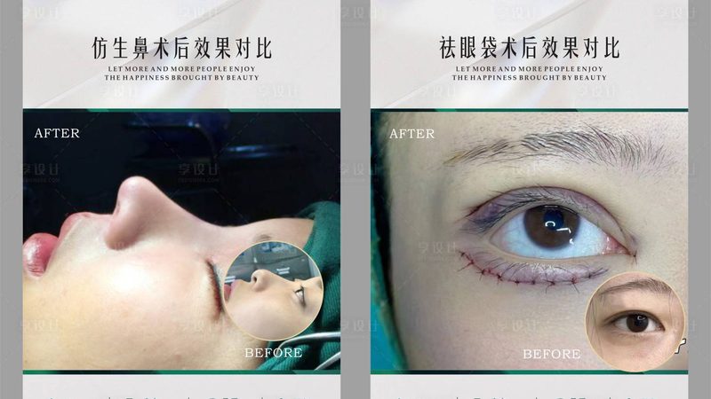 肉毒素去狐臭，效果如何？真实反馈揭秘