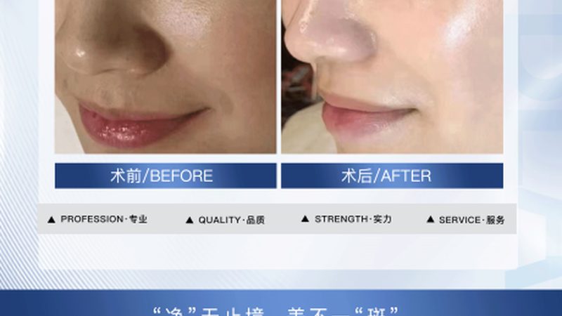 光子嫩肤的效果因人而异，一般来说，经过几次治疗，可以观察到以下效果：