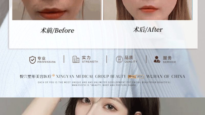 双眼皮手术，消肿后的价格几何？揭秘费用构成与影响因素**