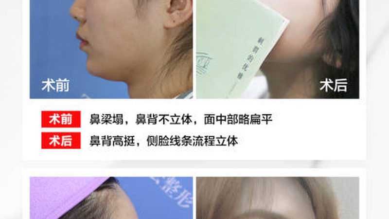 在青岛地区，以下医生在吸脂手术领域具有较高的声誉和丰富的经验：