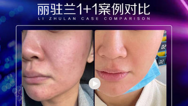 成都割双眼皮恢复期揭秘：了解这些，恢复无忧