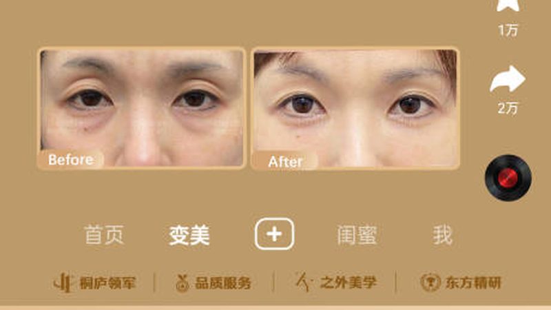 下颌角整形：风险与收益的理性分析