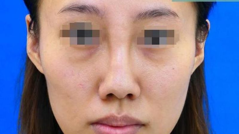 激光祛黄褐斑：揭秘治疗原理与选择要点